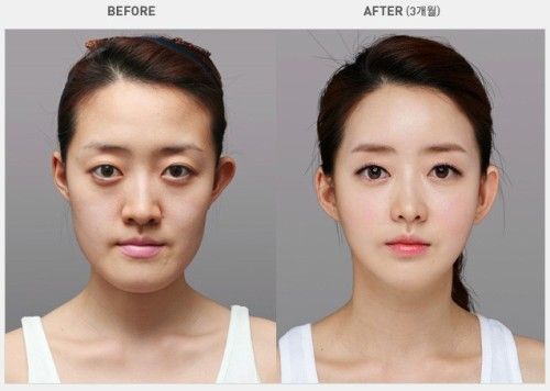 Asian plastic surgery pictures