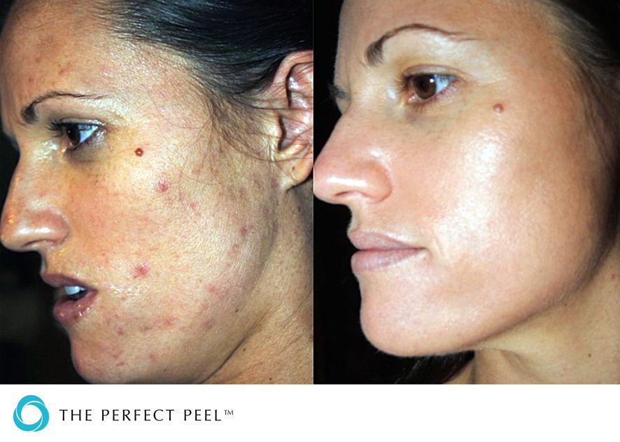 best of Peels laser rejuvenation Facial uk clinics