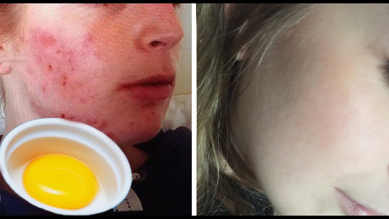 Honey and egg facial