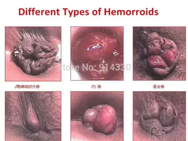 Parallax reccomend Hemorrhoids due to anal sex