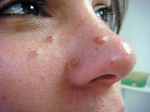 Treatment for fibrous papules facial angiofibroma