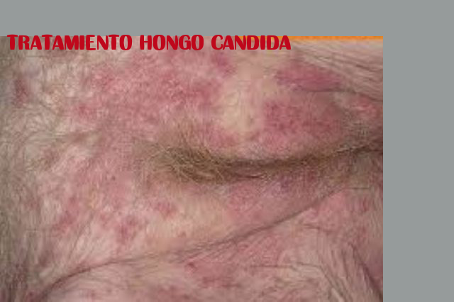 best of And Facial systemic candida hair