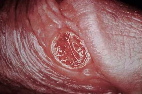 Syphilis oral sex