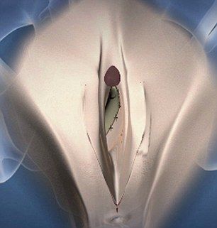Transsexual glue on sex organs