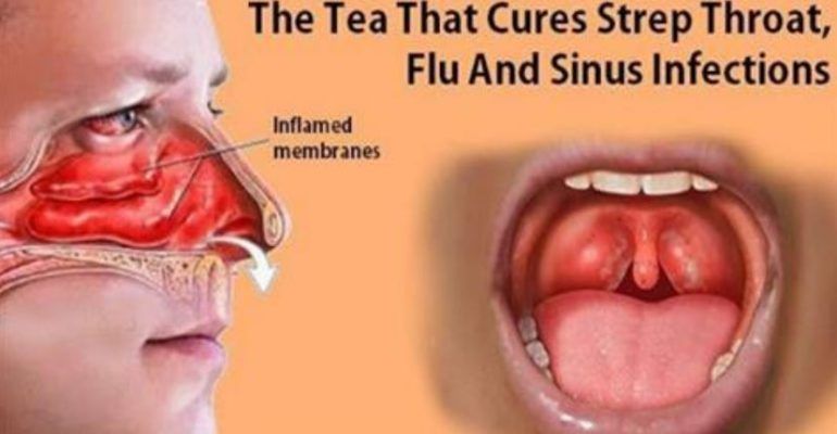 best of Throat sinuses Adult infection pictures