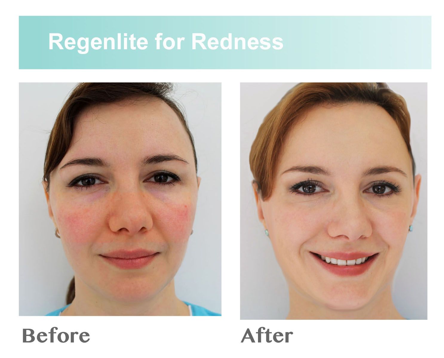best of Peels laser rejuvenation Facial uk clinics