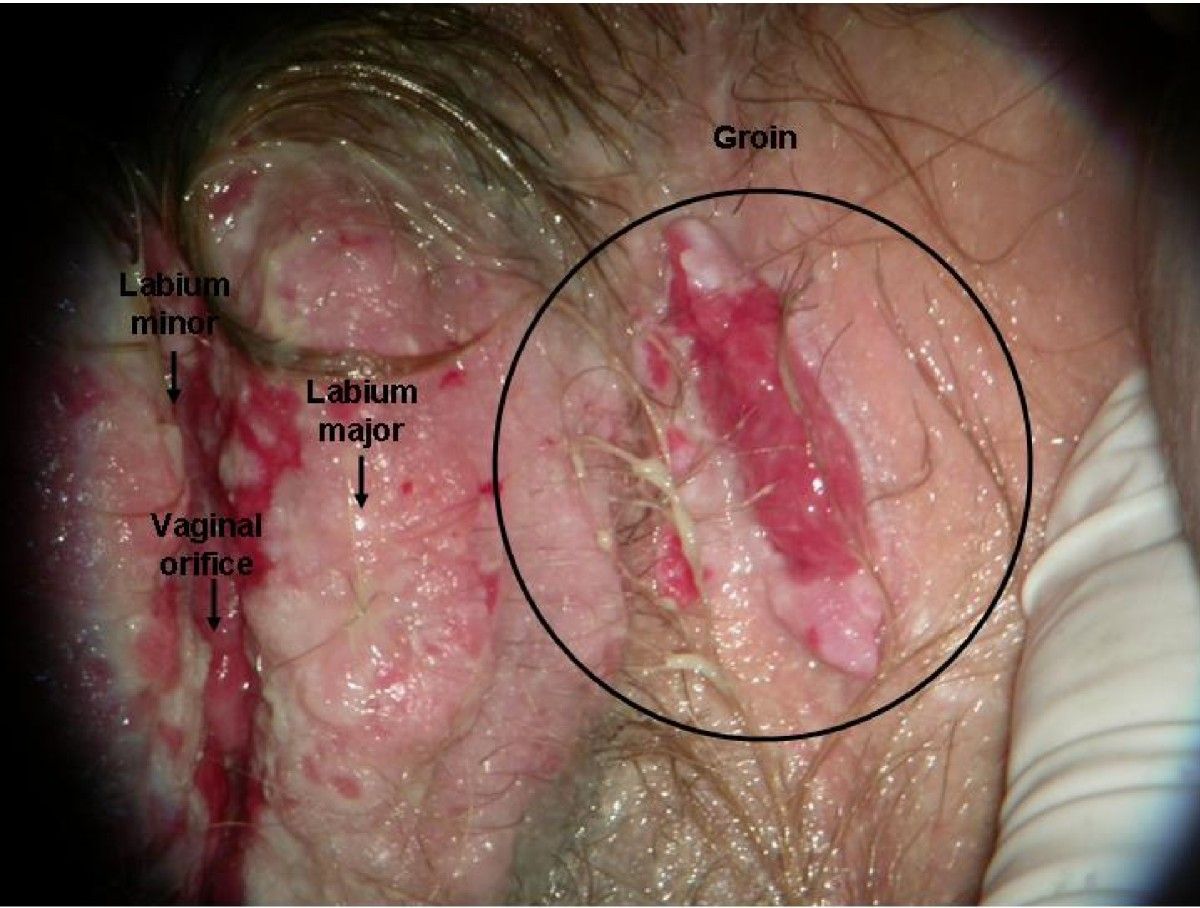 Squamous cell vulva lesion