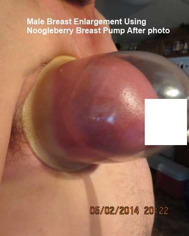 Male boob enlargement