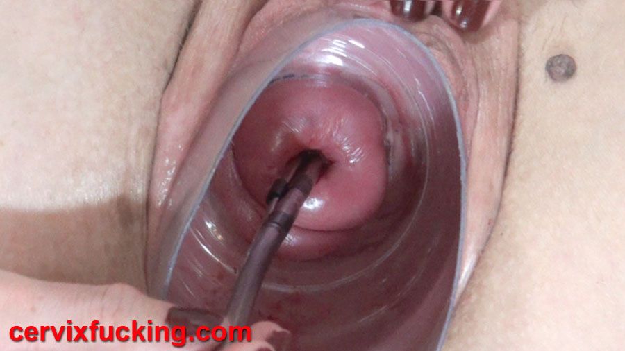 Cervical penetration sex