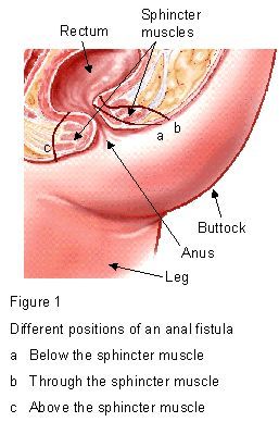 best of Picture anus Surgery loose