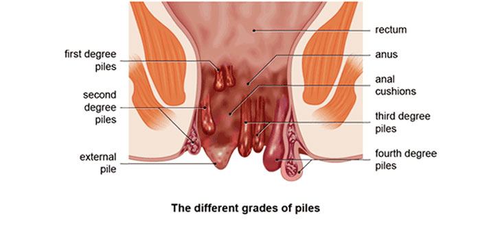 Pimple inside anus