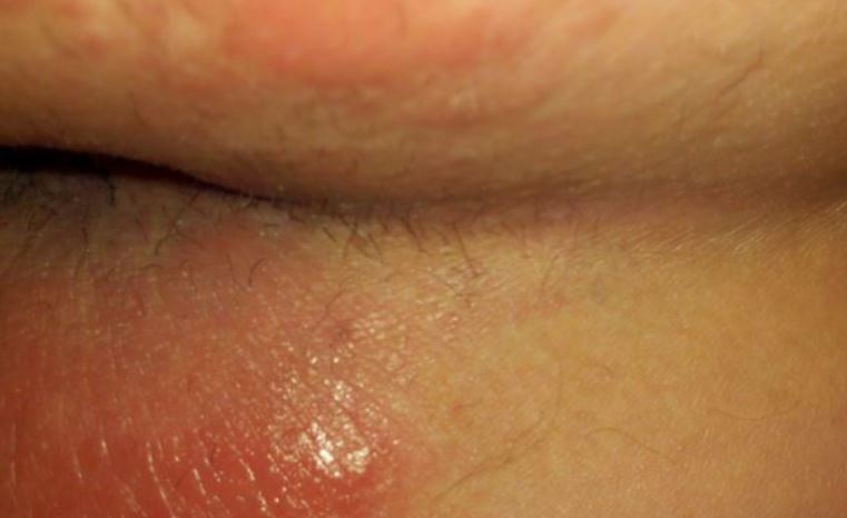 Infection in skin around anus