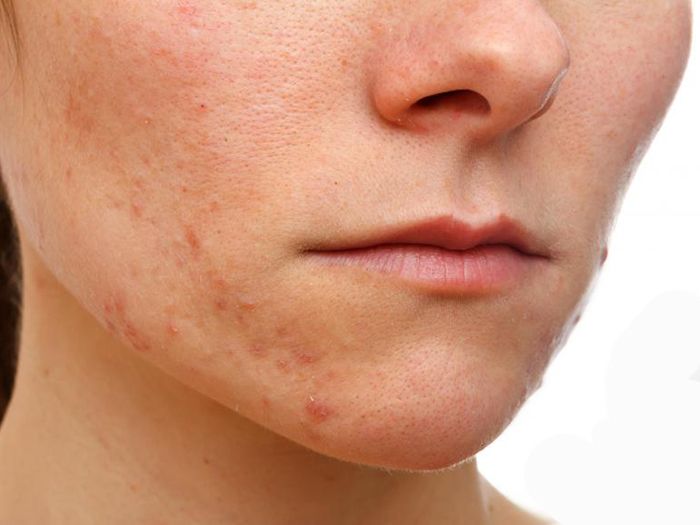 Facial for eczema