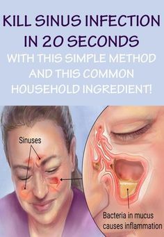 Adult throat infection pictures sinuses