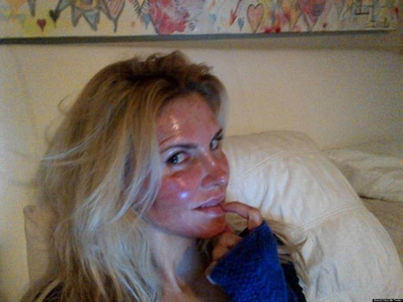 best of Burn facial Cure photo