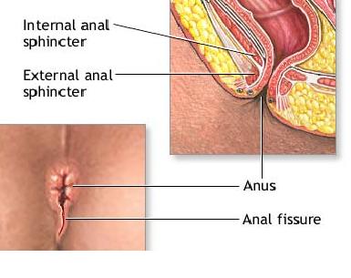 Cancer clean anus