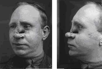 SвЂ™Mores reccomend Facial reconstructive surgery burn victim sample