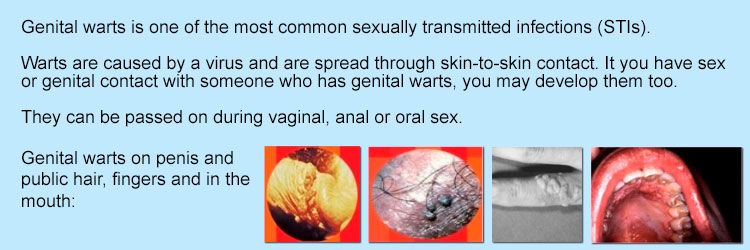 Genital warts contracted oral sex