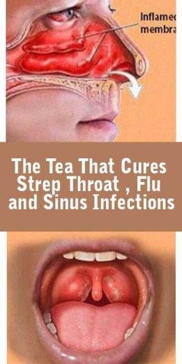 Mrs. R. reccomend Adult throat infection pictures sinuses