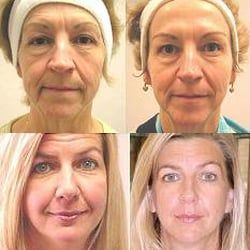Latest in facial sculpturing