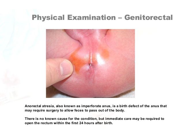 Birth defects anus rectum