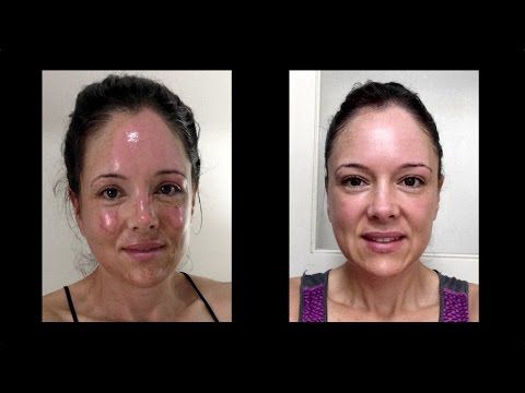 best of Burn facial Cure photo