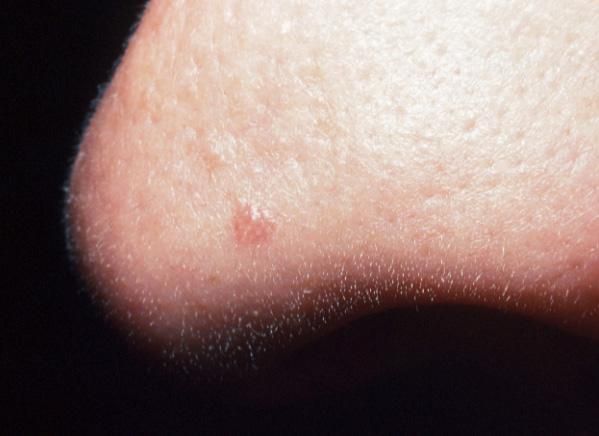 Infection in skin around anus