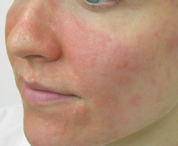 best of For eczema Facial
