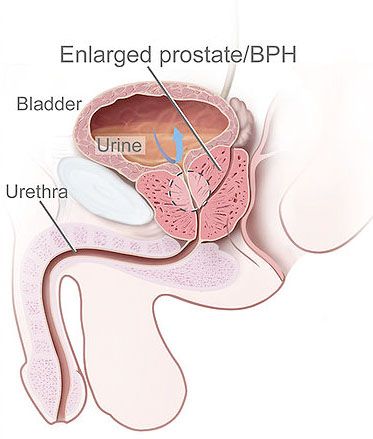 best of Prostate of cancer causes orgasm Theoretical