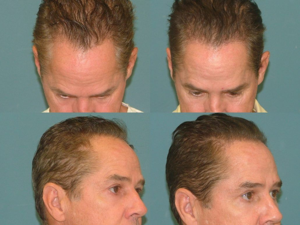Boss reccomend Facial hair restoration west palm beach