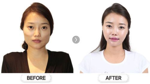 Robber reccomend Asian plastic surgery pictures