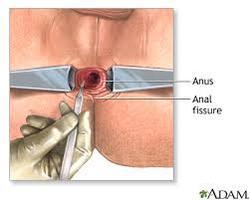 Pimple inside anus