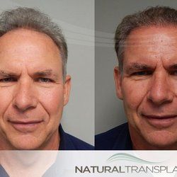 Facial hair restoration west palm beach