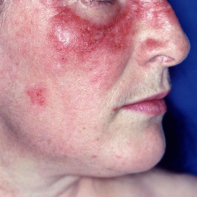 Facial rashes due to rheumatoid arthritis