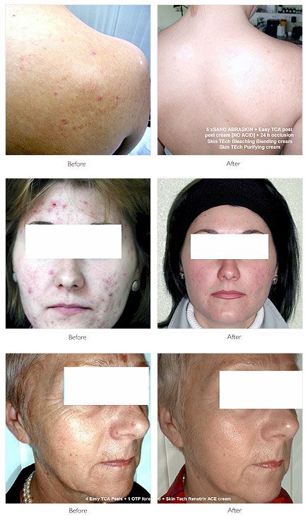 Facial rejuvenation clinics laser peels uk