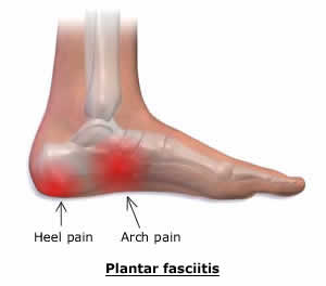 Cherry P. reccomend Foot walking pain bottom arch