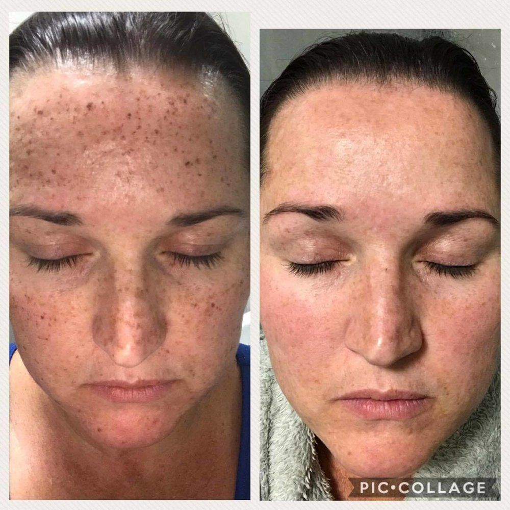 Mamsell reccomend Ipl facial results