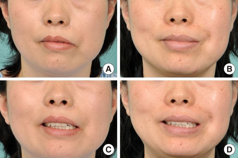 Sling facial paraylsis reconstruction