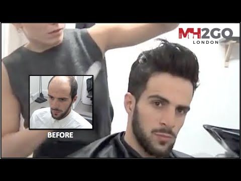 Treatment For Hair Fall In Men Free Pron Videos 2018