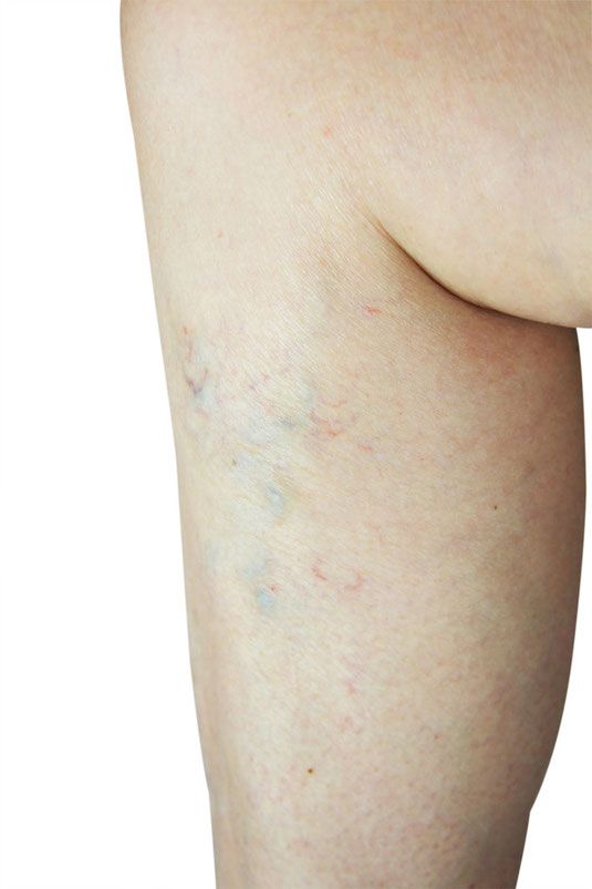 best of Leg nicked shaved Treatment vein of